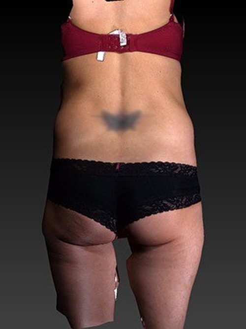 Tummy Tuck Before & After