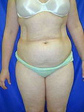 Tummy Tuck Before & After