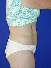 Tummy Tuck Before & After