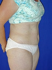 Tummy Tuck Before & After