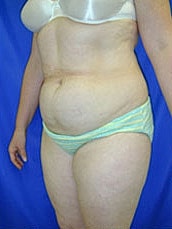 Tummy Tuck Before & After