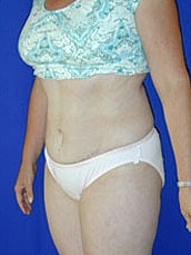 Tummy Tuck Before & After