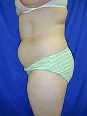 Tummy Tuck Before & After