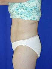Tummy Tuck Before & After