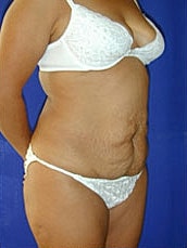 Tummy Tuck Before & After