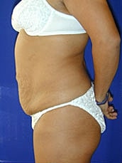 Tummy Tuck Before & After