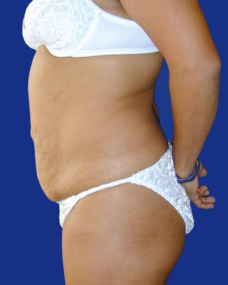 Tummy Tuck Before & After