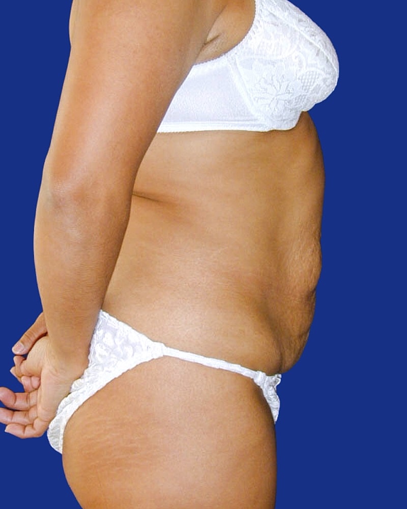 Tummy Tuck Before & After