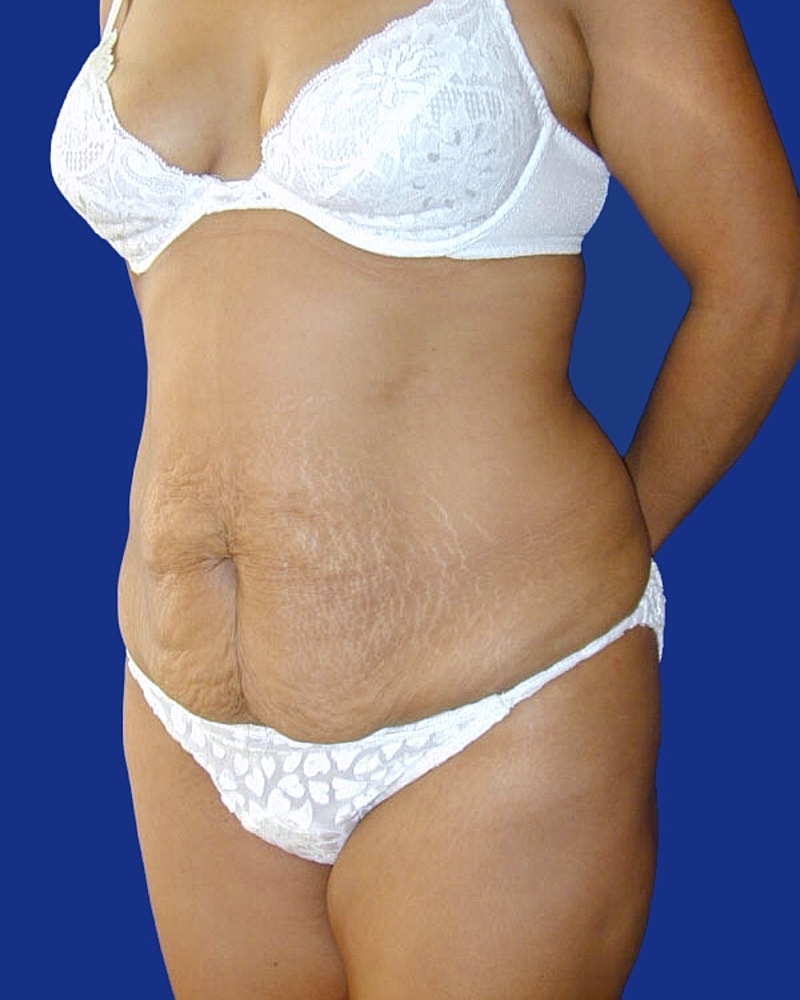 Tummy Tuck Before & After