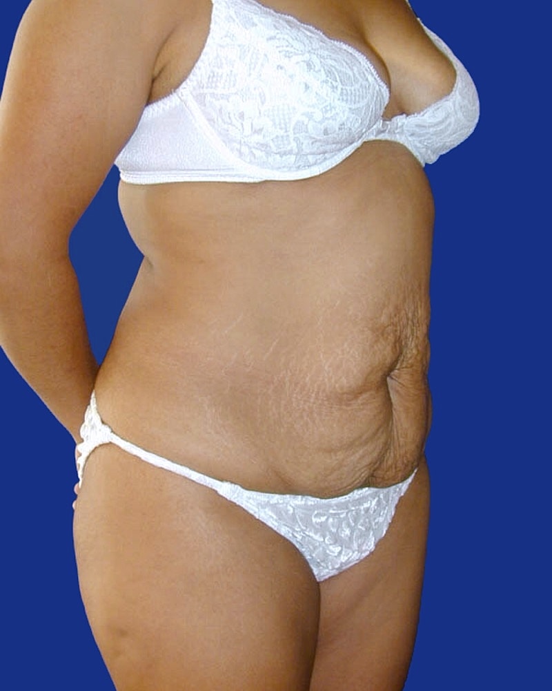 Tummy Tuck Before & After