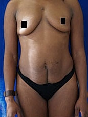 Tummy Tuck Before & After