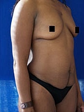 Tummy Tuck Before & After