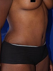 Tummy Tuck Before & After