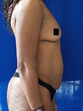 Tummy Tuck Before & After