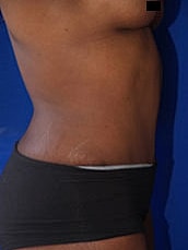Tummy Tuck Before & After