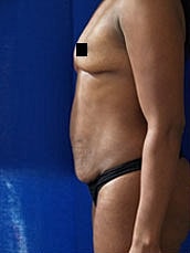 Tummy Tuck Before & After