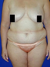 Tummy Tuck Before & After