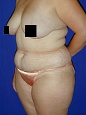Tummy Tuck Before & After