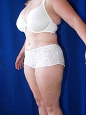 Tummy Tuck Before & After