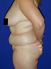 Tummy Tuck Before & After