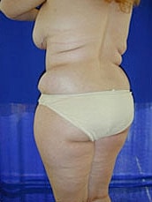 Tummy Tuck Before & After