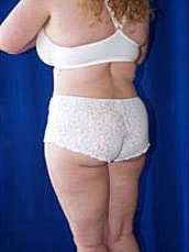Tummy Tuck Before & After