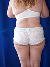 Tummy Tuck Before & After