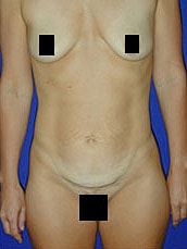 Tummy Tuck Before & After