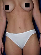 Tummy Tuck Before & After