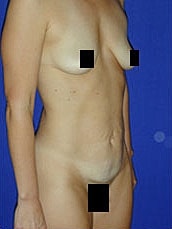 Tummy Tuck Before & After
