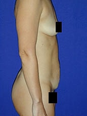 Tummy Tuck Before & After