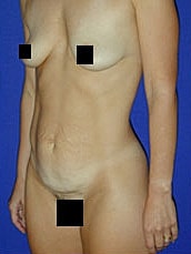 Tummy Tuck Before & After