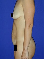 Tummy Tuck Before & After