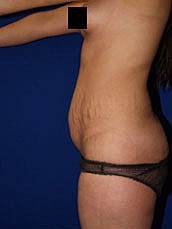 Tummy Tuck Before & After