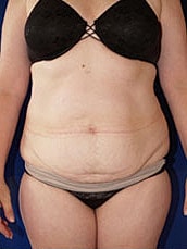 Tummy Tuck Before & After