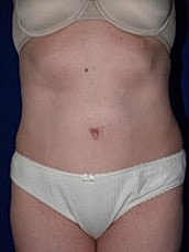 Tummy Tuck Before & After
