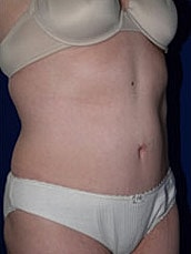 Tummy Tuck Before & After