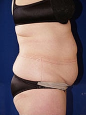 Tummy Tuck Before & After