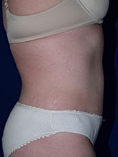 Tummy Tuck Before & After