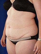 Tummy Tuck Before & After