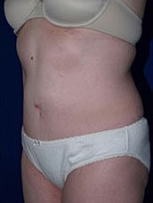 Tummy Tuck Before & After