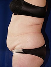 Tummy Tuck Before & After