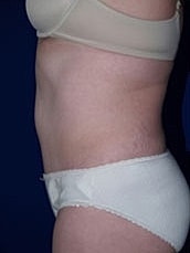 Tummy Tuck Before & After