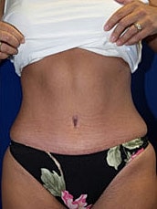 Tummy Tuck Before & After