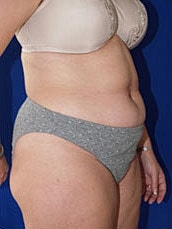 Tummy Tuck Before & After