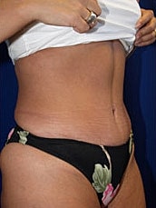 Tummy Tuck Before & After