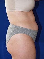 Tummy Tuck Before & After