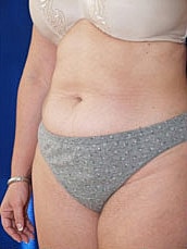 Tummy Tuck Before & After