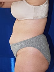 Tummy Tuck Before & After
