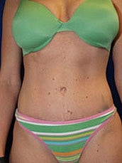 Tummy Tuck Before & After